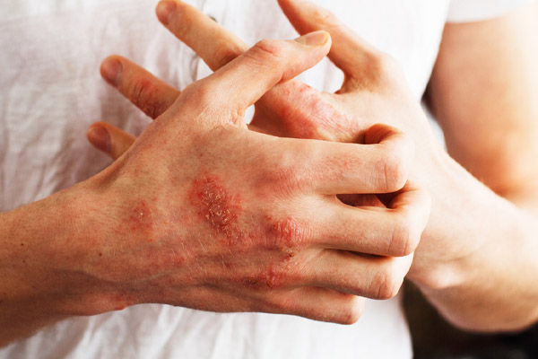 image of eczema and hvac indoor air quality